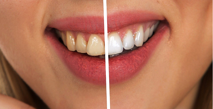 5 Surprising Teeth Whitening Tips